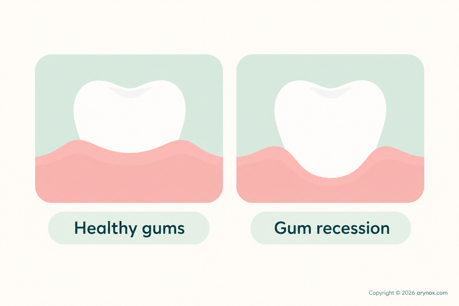 Educational comparison showing healthy gum levels and gum recession